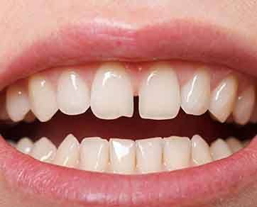 Close-up of mouth with crowded teeth in lower arch