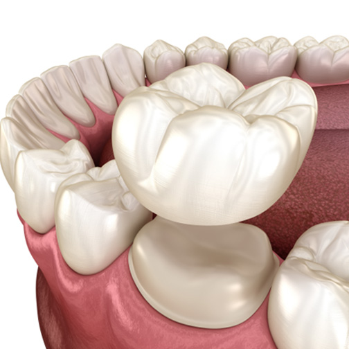 Illustration of a dental crown being placed on a prepared tooth