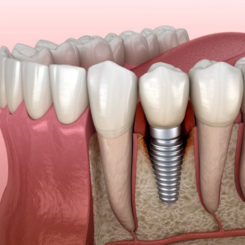 Illustration of bone loss around failed dental implant in Fort Worth, TX
