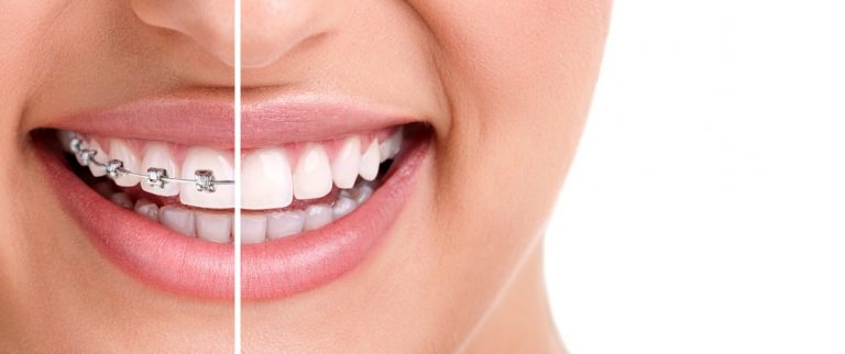 White Spots After Braces? Learn How Cosmetic Dentistry Can