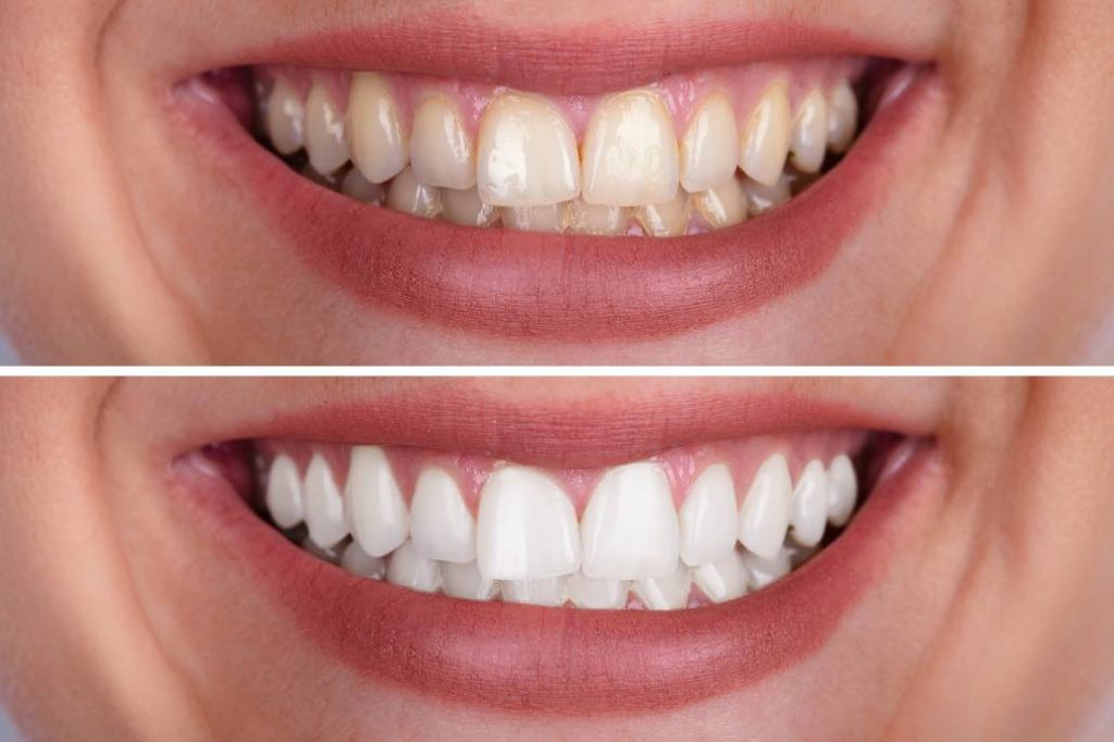 How Does Teeth Whitening Work And Can It Cause Sensitivity 