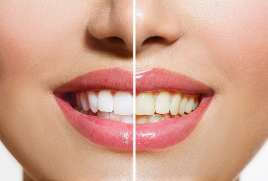 Nose-to-chin view of woman with teeth half whitened for before/after results